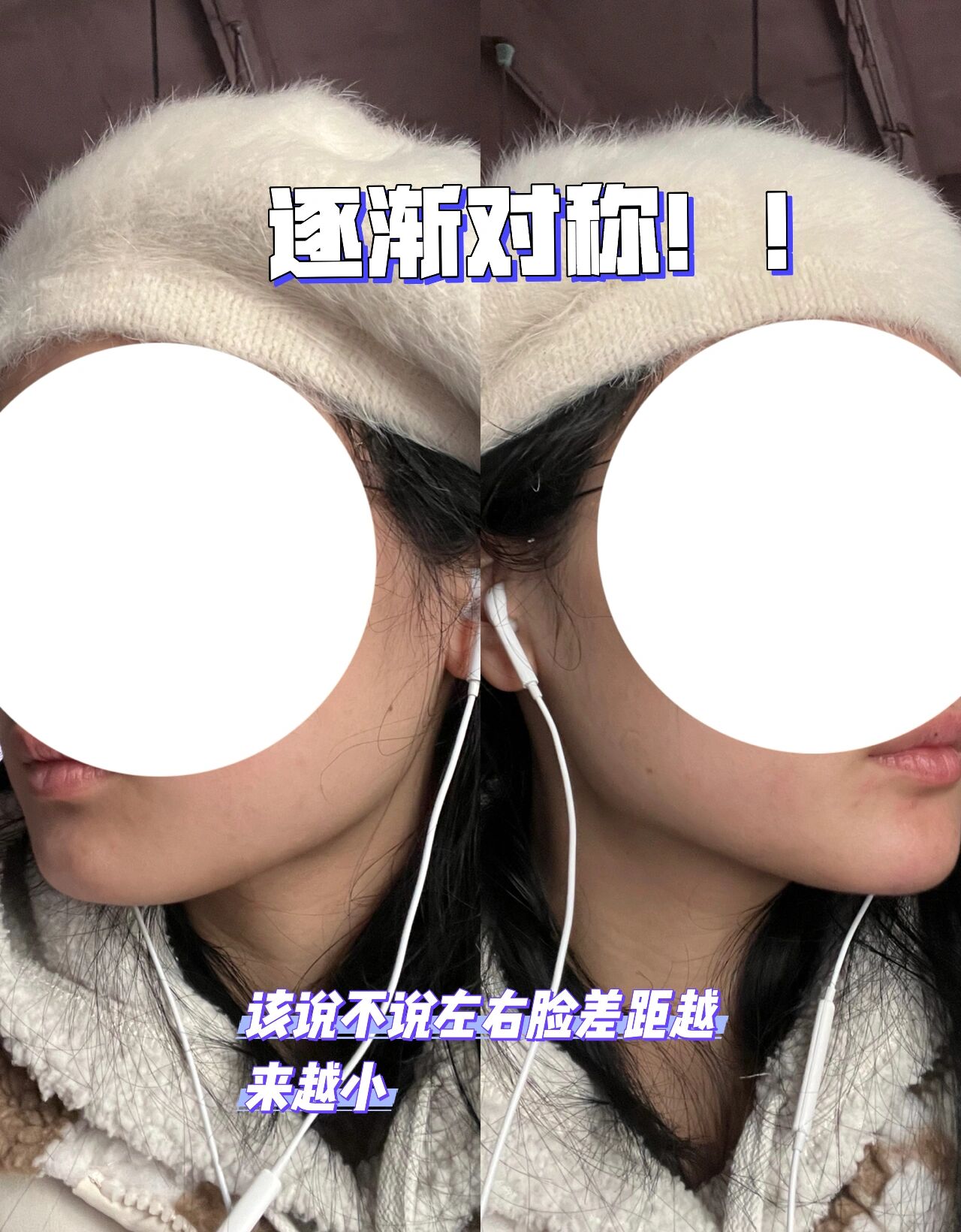 骨性大小脸终于得救 大小脸很久了,之前说的托腮法改善得比之前快太多