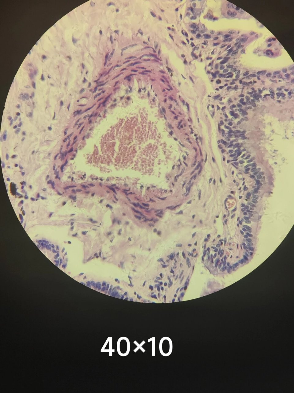 慢性肺淤血光镜下结构. 慢性肺淤血