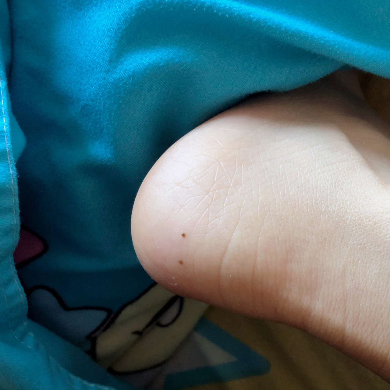 有听说脚上长痣容易癌变01