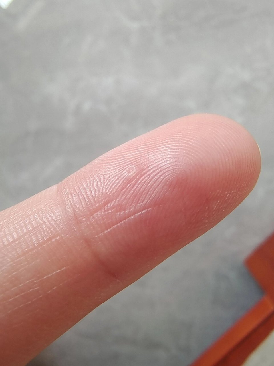 手指上长了个小疙瘩,不知道是啥 像个硬茧子 扣一下有点点疼
