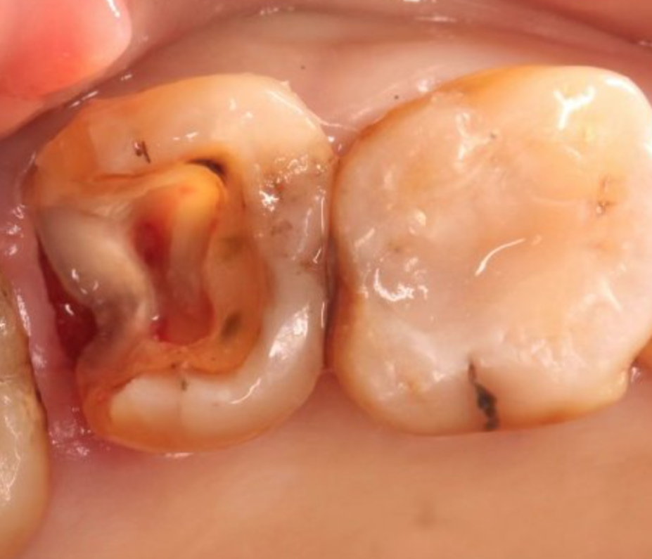 躺下就牙疼,起来活动就不疼,这种情况很可能是牙髓炎的早期表现