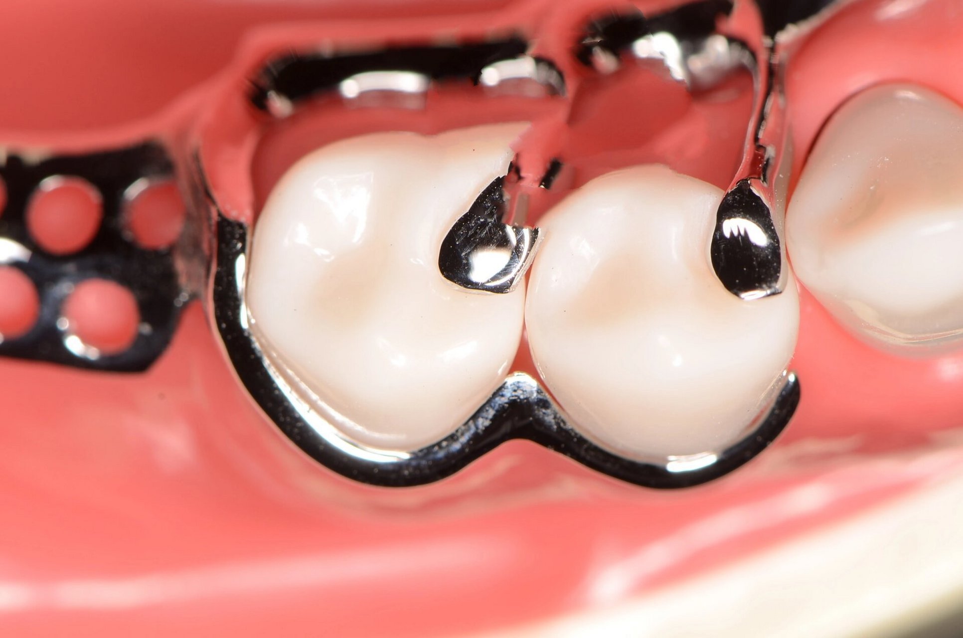 合支托预备和各种卡环 牙合支托凹的制备 制备原则 一般制备在缺隙