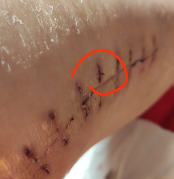 但少数人对蛋白线有排异反应,可能导致伤口感染,渗液,这时候要密切