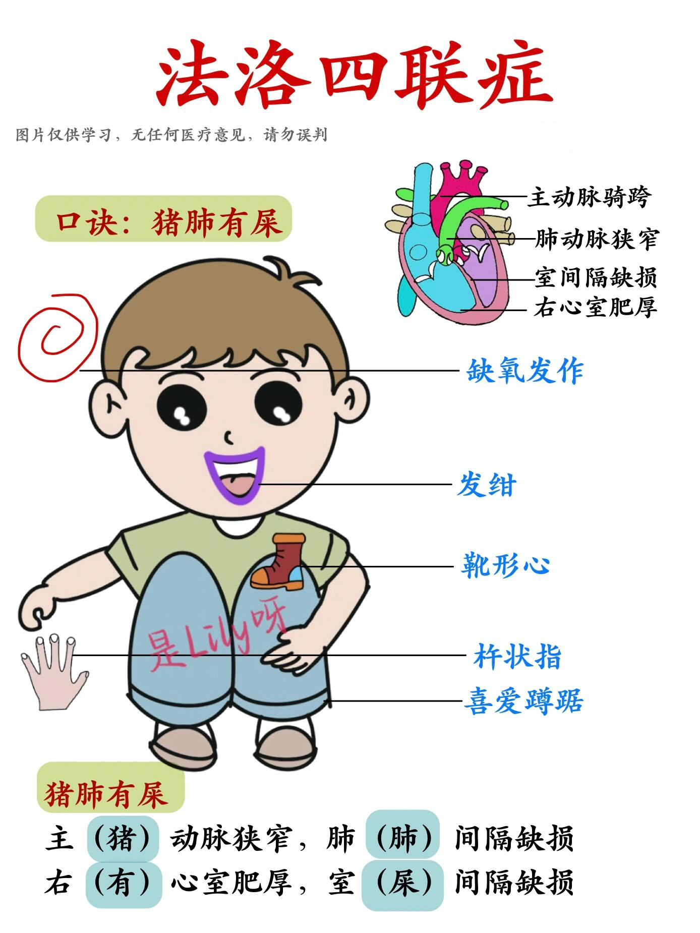 整理笔记94法洛四联症