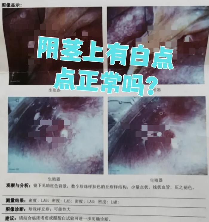 最常见的原因有三种:珍珠状阴茎丘疹,念珠菌性包皮龟头炎或急性浅表性