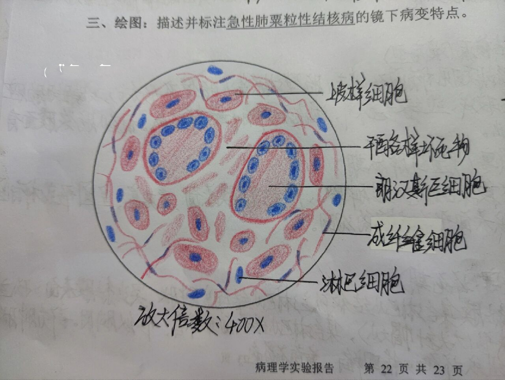 病理学红蓝铅笔绘图(全) ①肾近曲小管上皮细胞水肿 ②肺动脉内混合