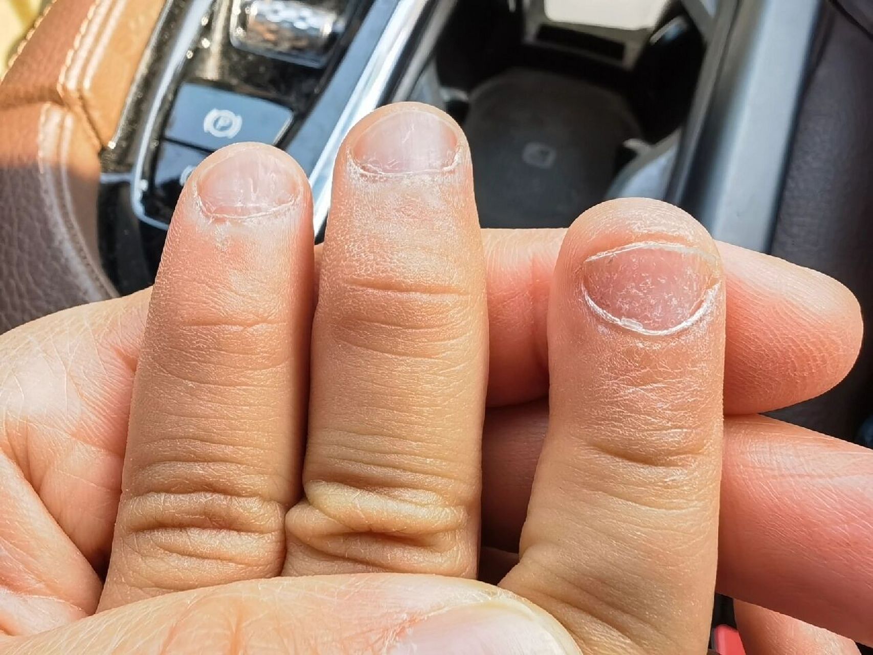 七岁半男孩手指甲盖坑坑洼洼的 之前给儿子剪指甲的时候就发现指甲盖
