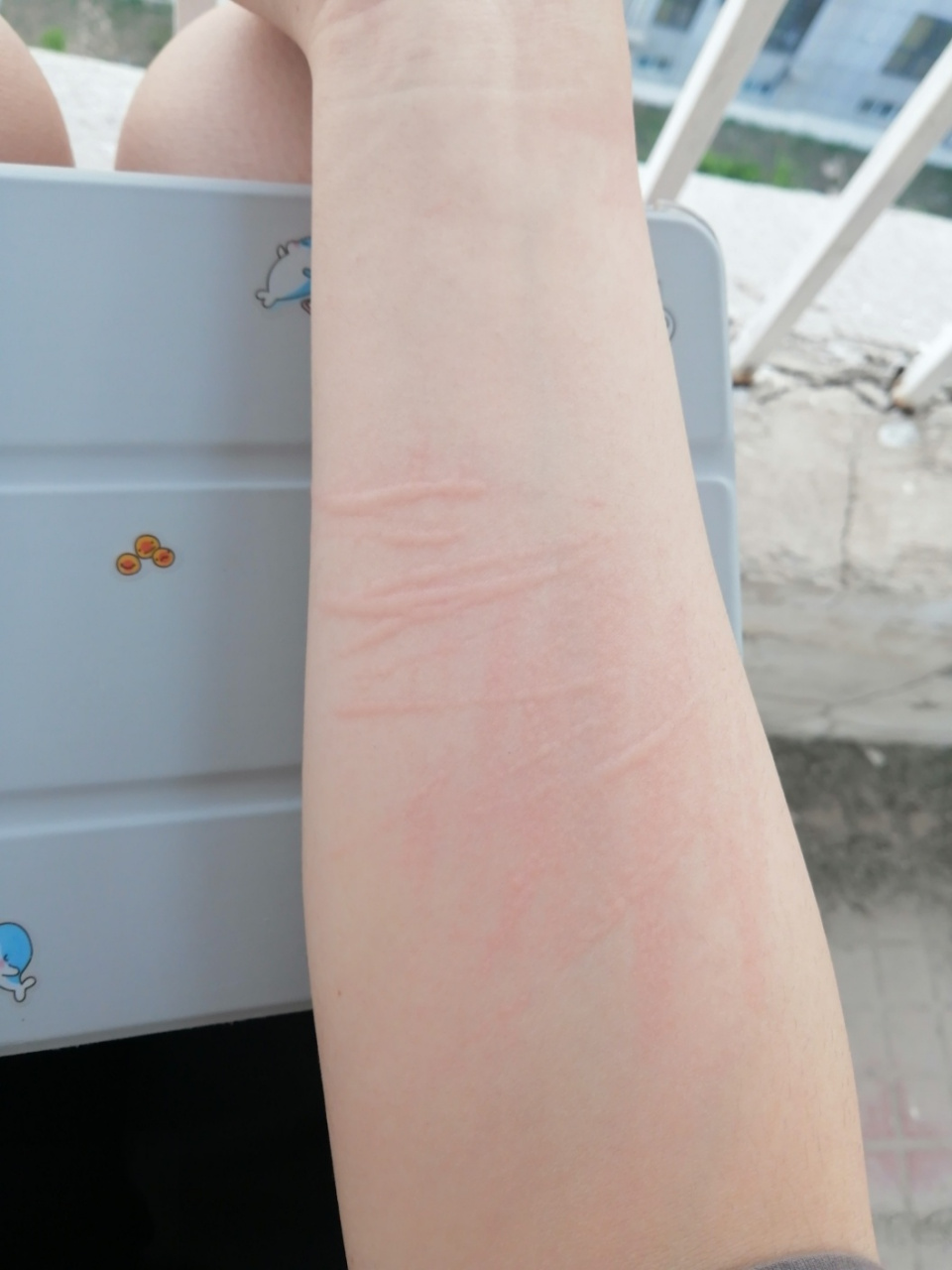 皮肤划痕症 我只不过是搬凳子硌到了  好痒