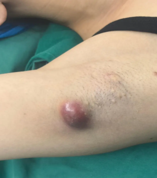 腋下痘痘挤出白色的固体怎么回事怎么办?