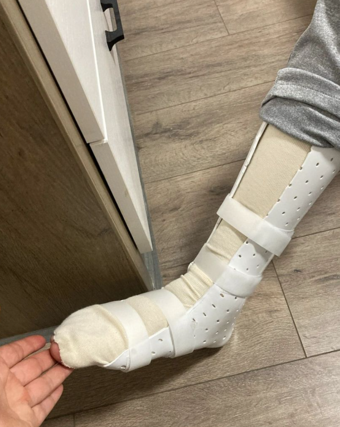 打了石膏后脚越来越肿,常见原因有三个:石膏过紧,软组织损伤和骨