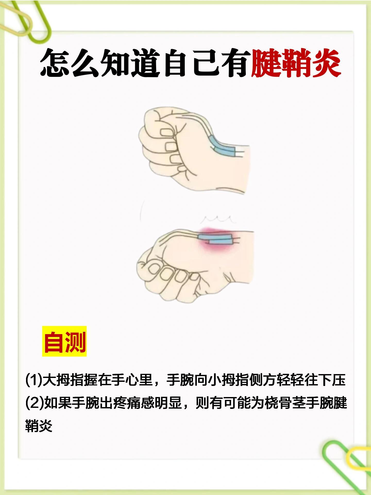 预防 1,注意休息 2,正确握鼠标 3,腱鞘操 - 治疗 贴傅豫堂膏药,椅次