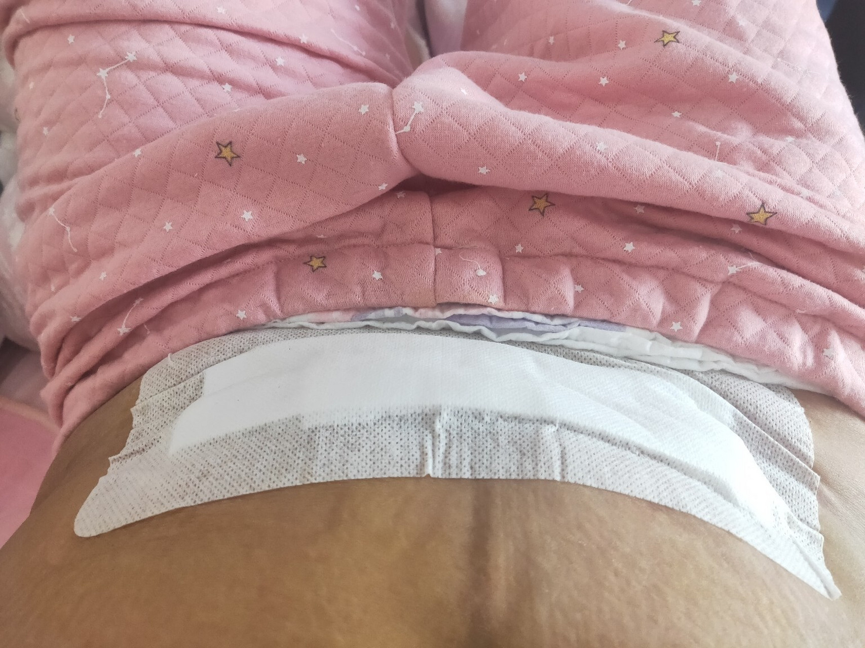 剖腹产脂肪液化95换药生疼.