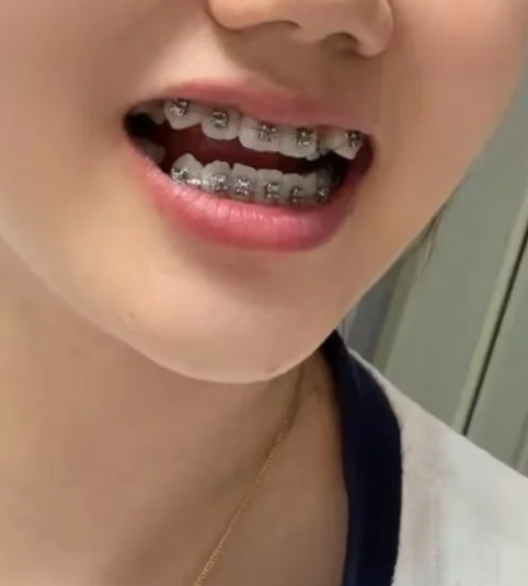 如果上下门牙明显对不齐,可能是牙齿畸形的表现.牙齿畸形包括牙齿