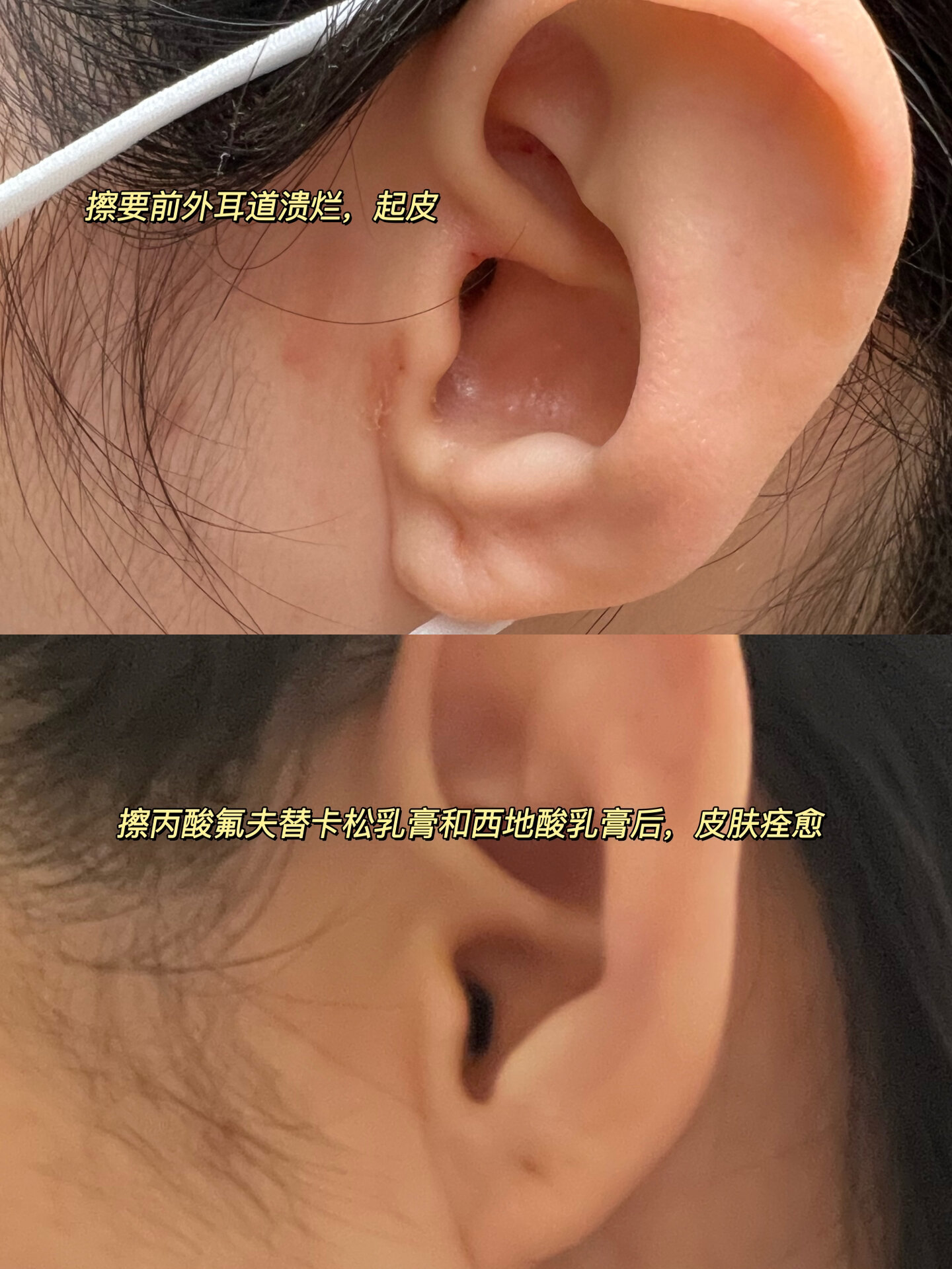 外耳道湿疹|反复发作看过来 21年夏天耳朵周围突发湿疹,一发不可收拾.