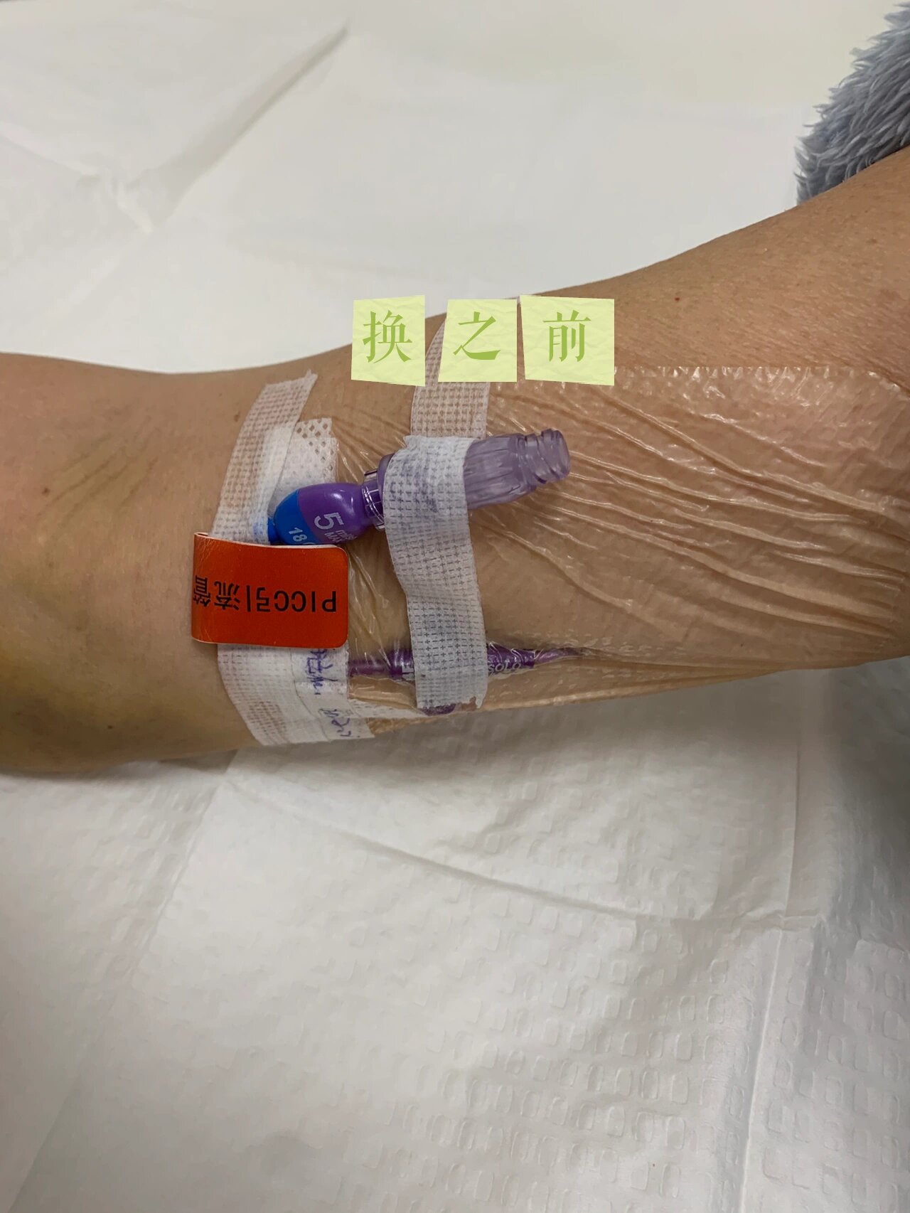 浅谈输液接头 这次换 肝素帽接头:最不推荐使用的接头,因为这个不做到