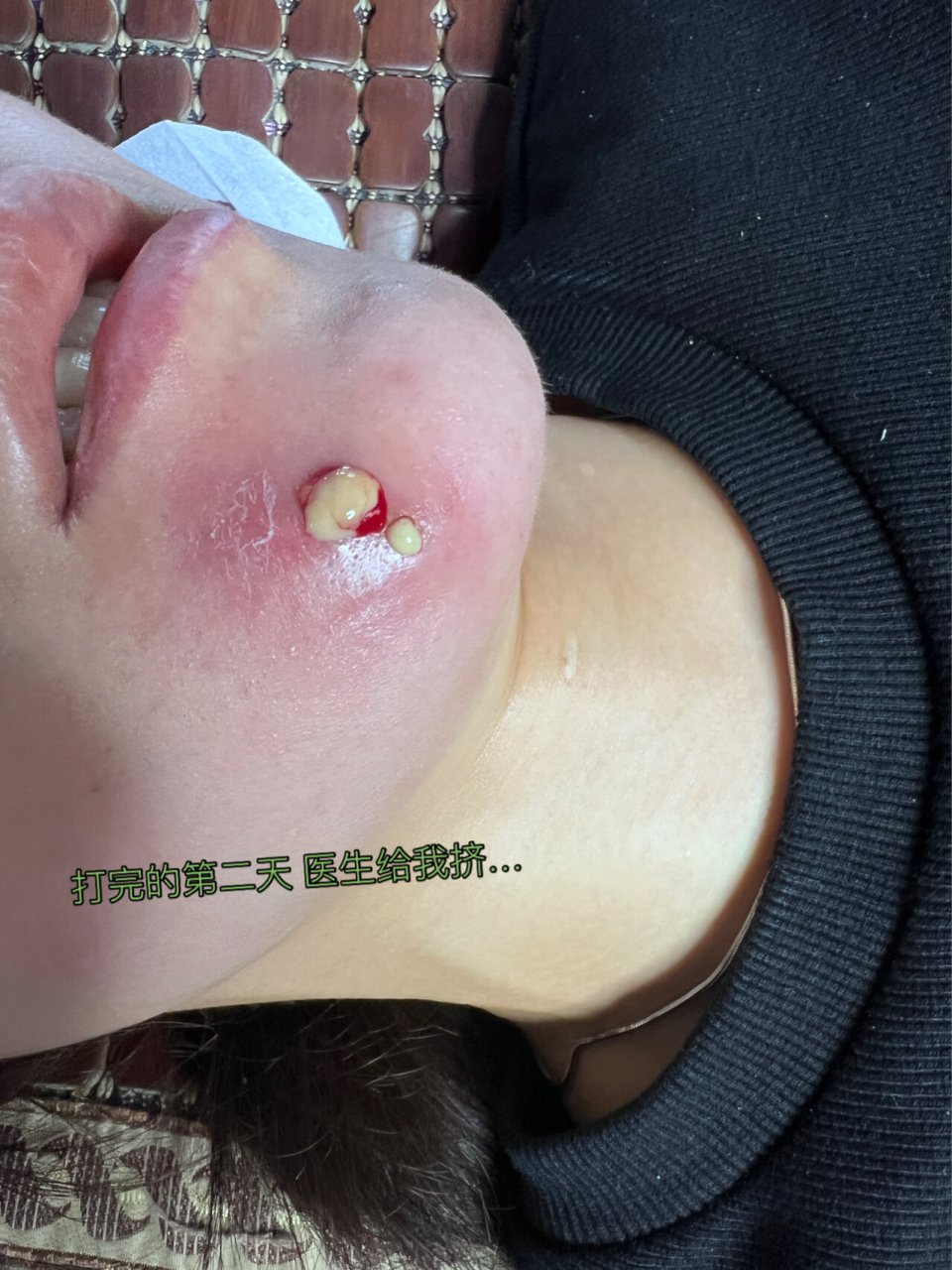 下巴的火疖子 以为就是小小的一个小豆 没想到隔了一天又红又硬 还