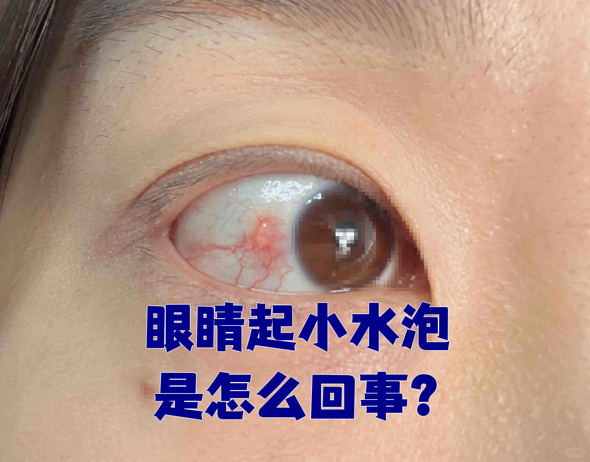 眼睛起小水泡通常和下面几种情况有关: