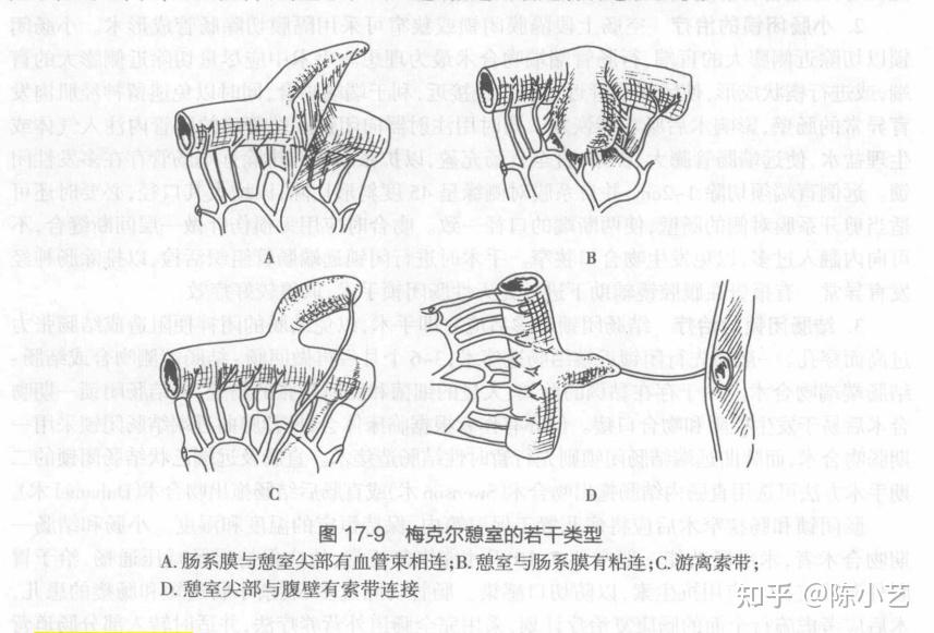 梅克尔憩室超声图表现图片