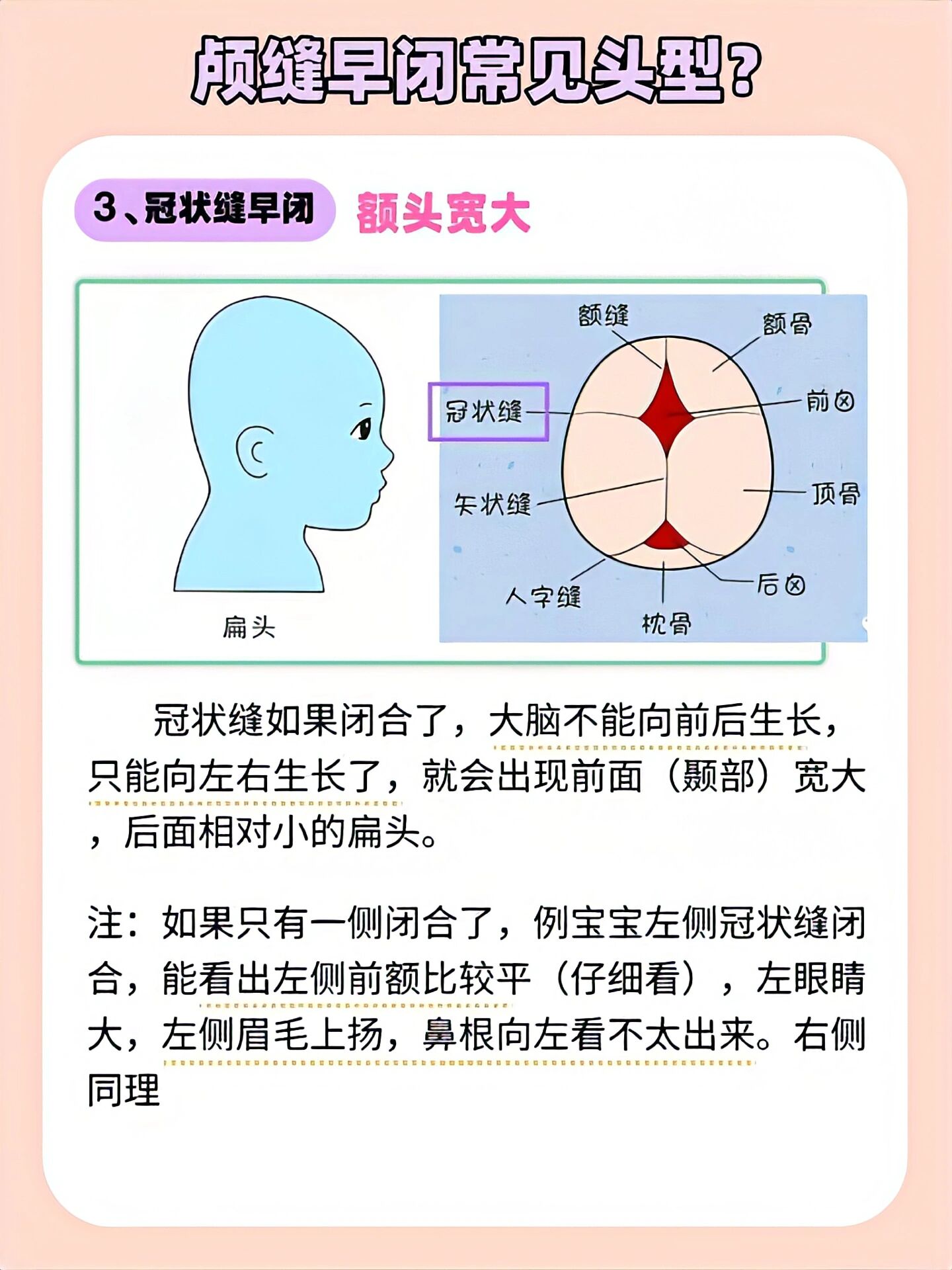 颅缝早闭手术成功率图片