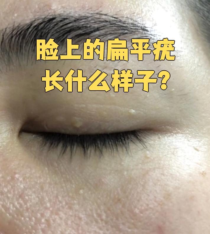 脸上的扁平疣长什么样子?