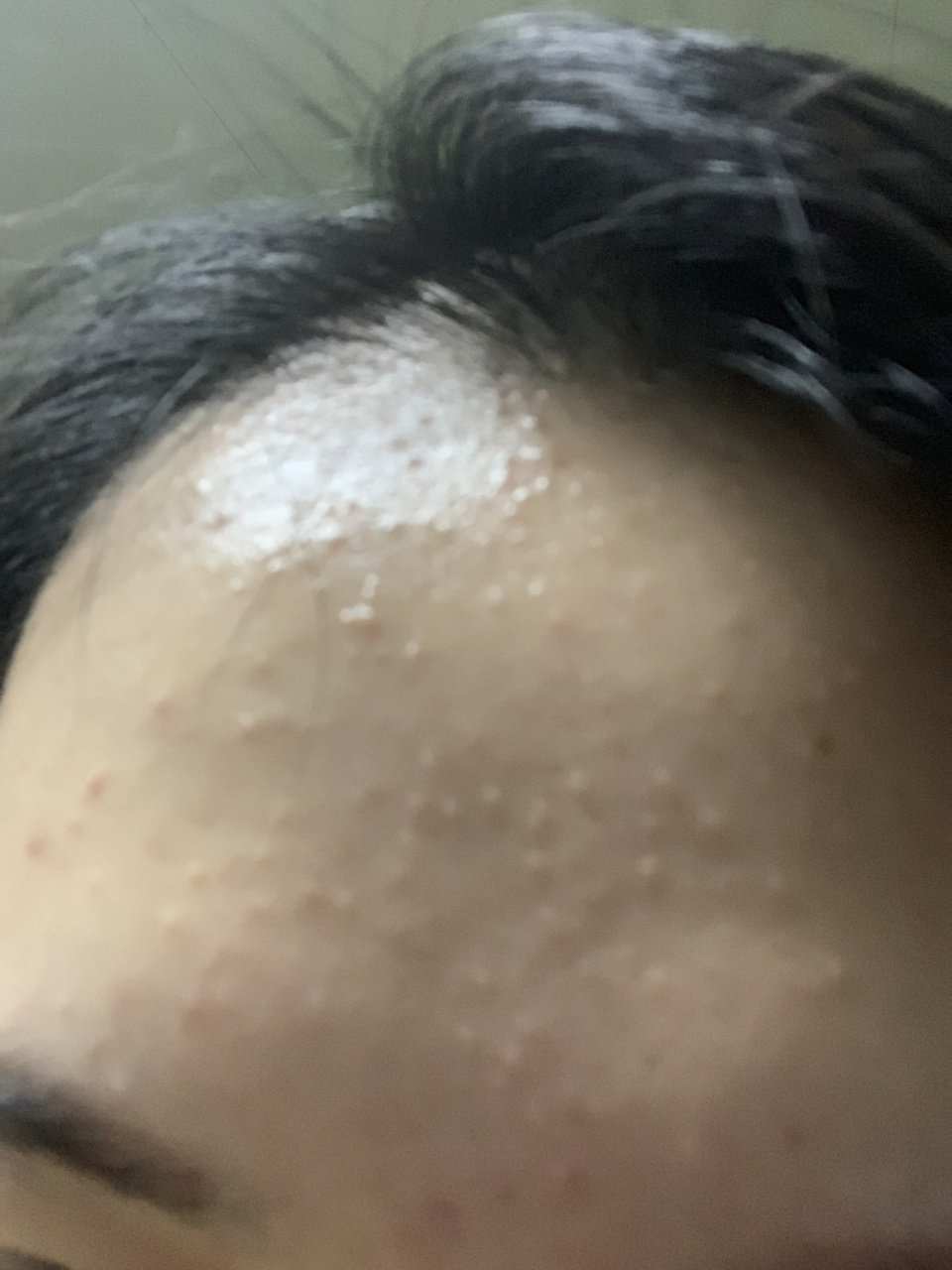 额头上突然长了很多密密麻麻的小点 有什么好的办法嘛 去医院医生说是