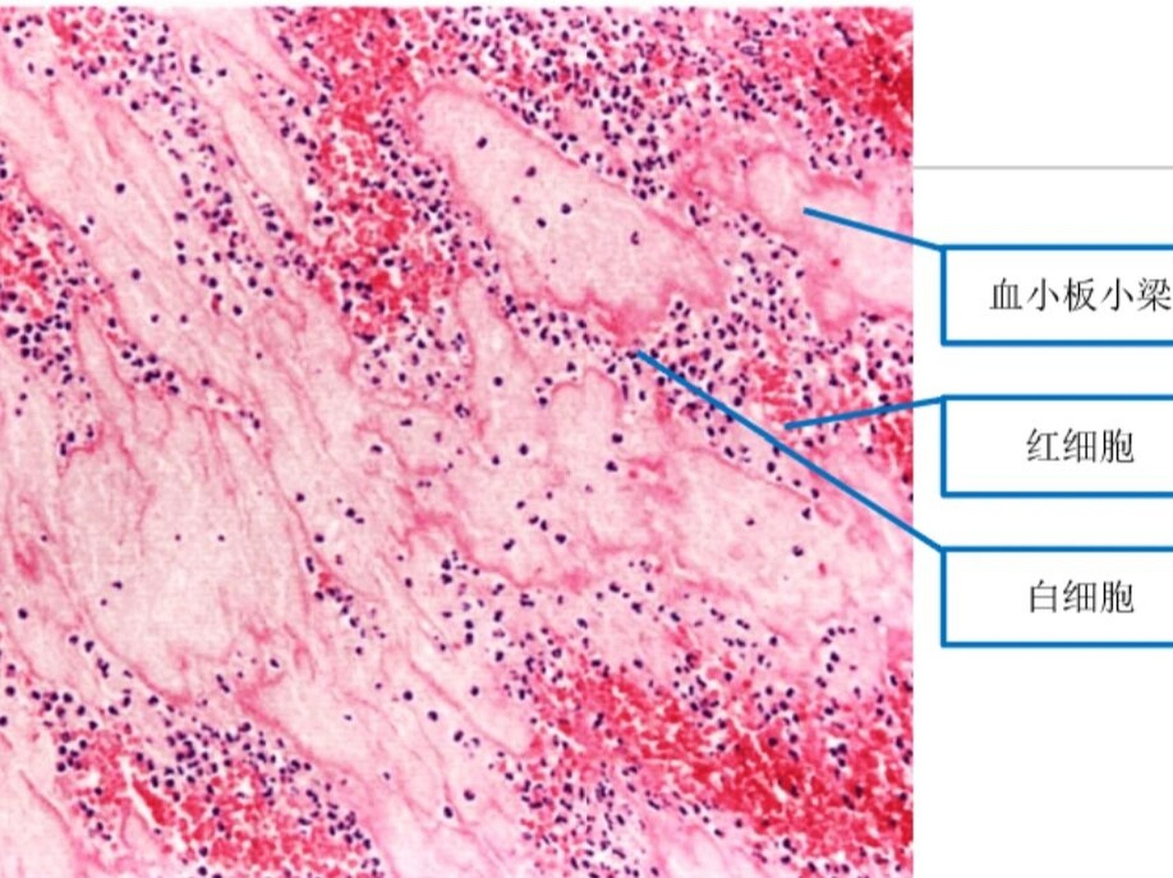 病理实验课_混合血栓 混合血栓红蓝铅笔绘图