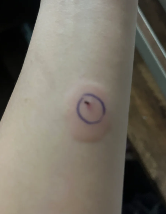 ppd试验结果要看皮试后72小时皮肤硬结的大小,不是看红晕的范围