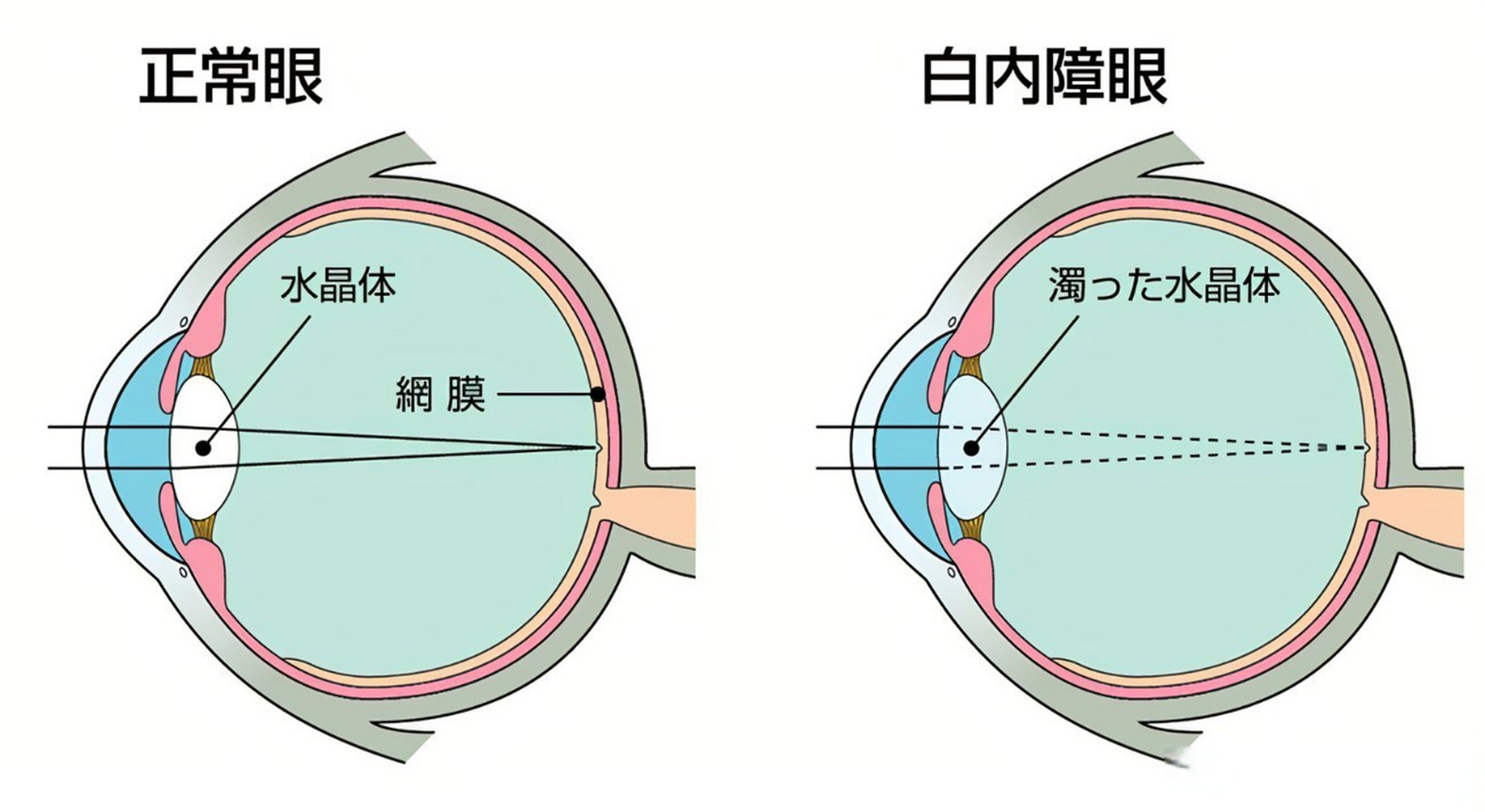 18张常见白内障图解图片