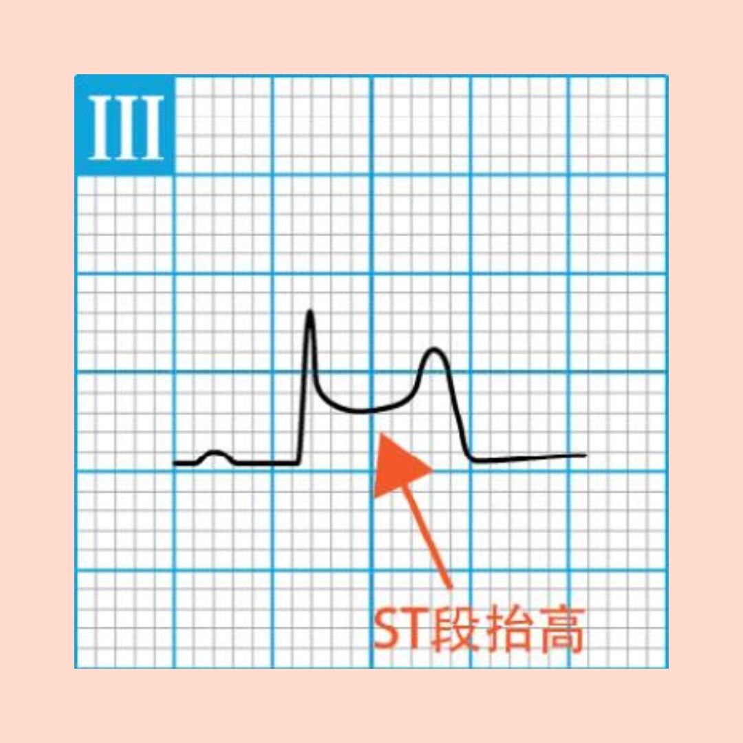 day7:怎么看出心电图的st段是抬高的?