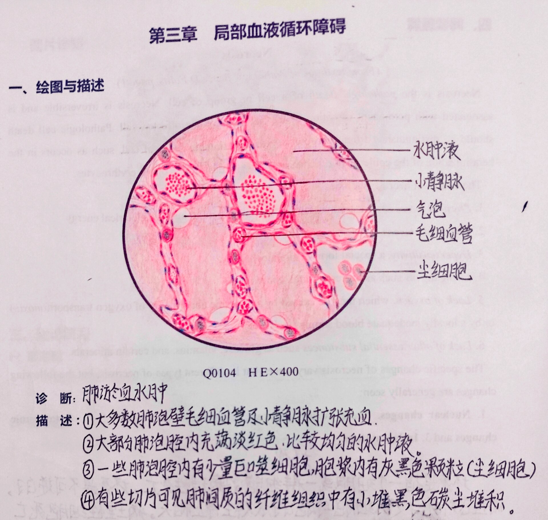 肺淤血绘图图片