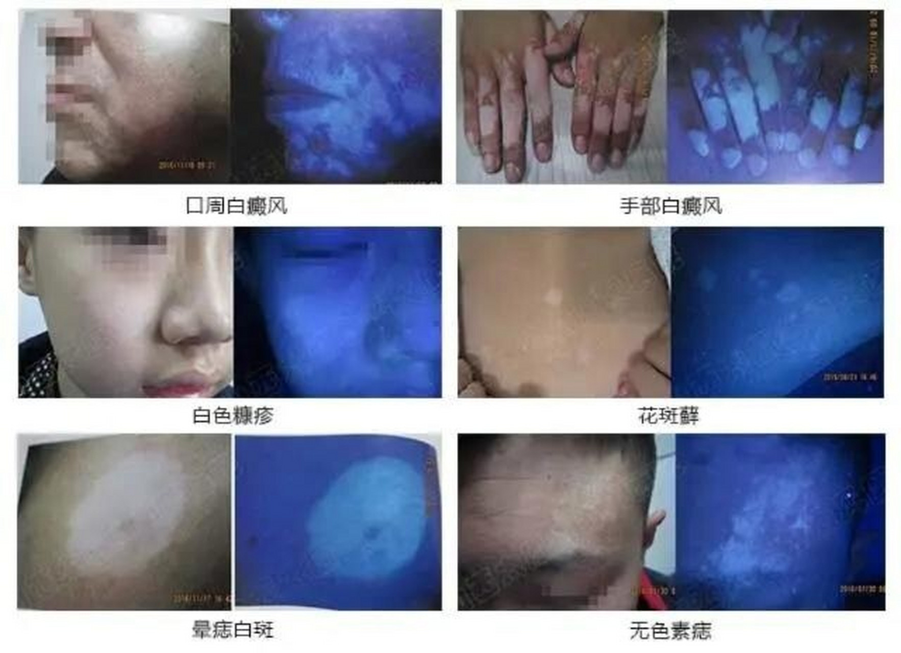 伍德灯下白斑各种类型.