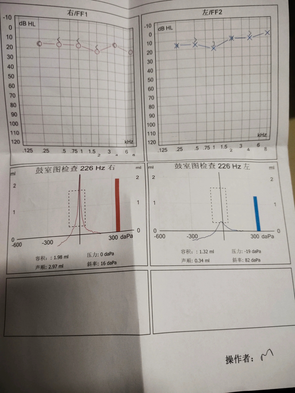 右耳耳鸣 右耳耳鸣快两个月了,检查听力正常,鼓室图左右耳不一样,是