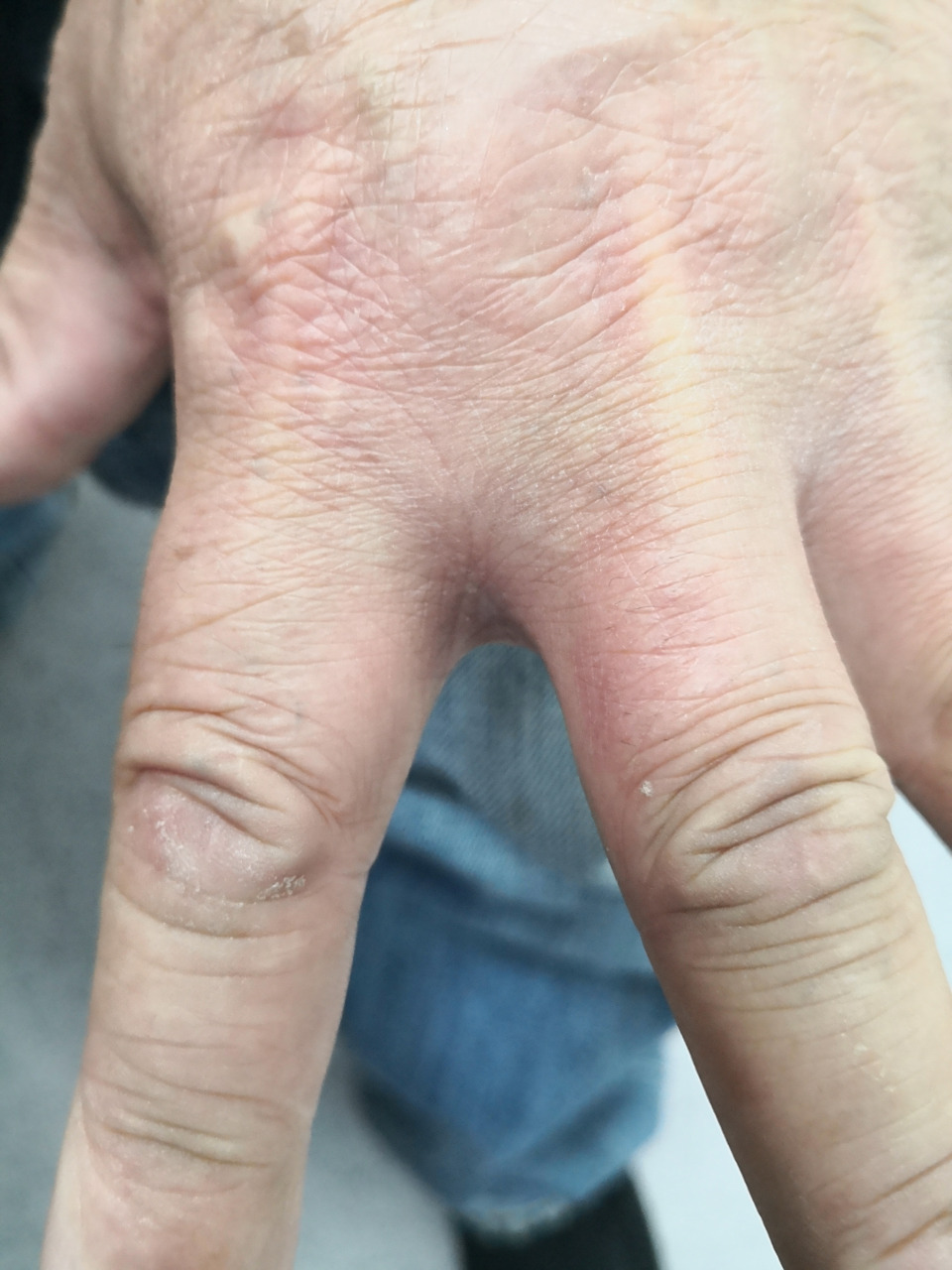 疥疮症状需要仔细排查诊断.