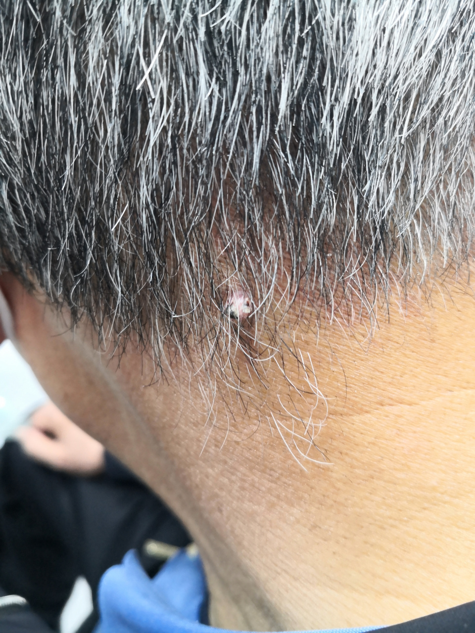 头皮枕下的皮肤肿物.