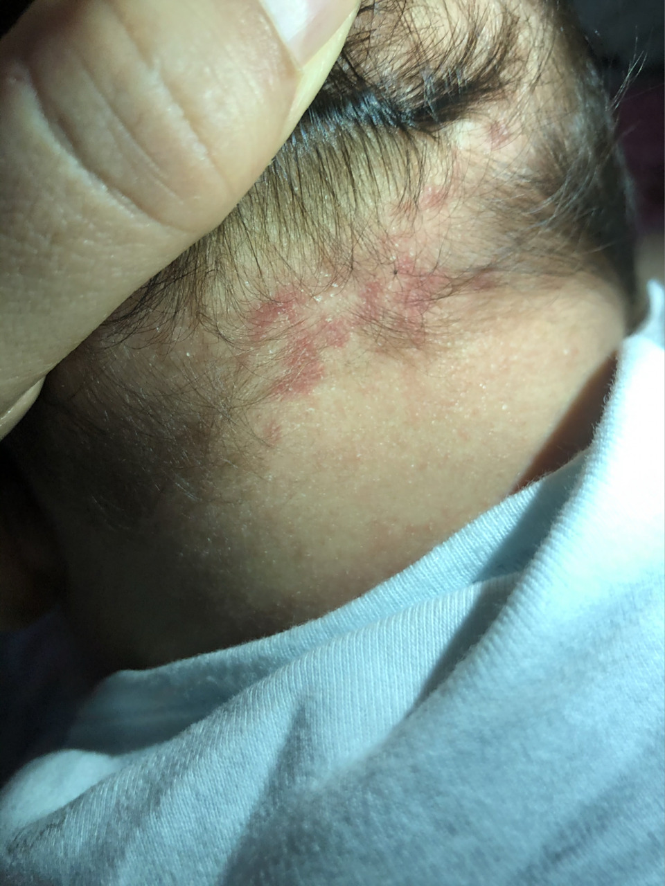 今天晚上才发现儿子后脑勺有一片红斑 当时看到,脑子一下蒙了,当时