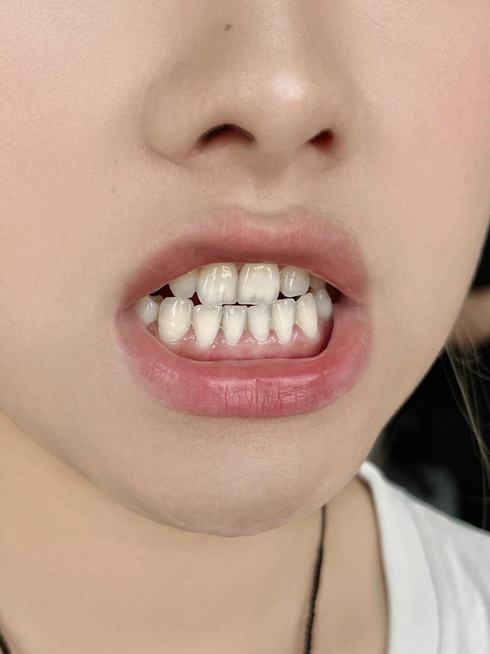 爽到飞起,2年牙周炎就这么没有了!