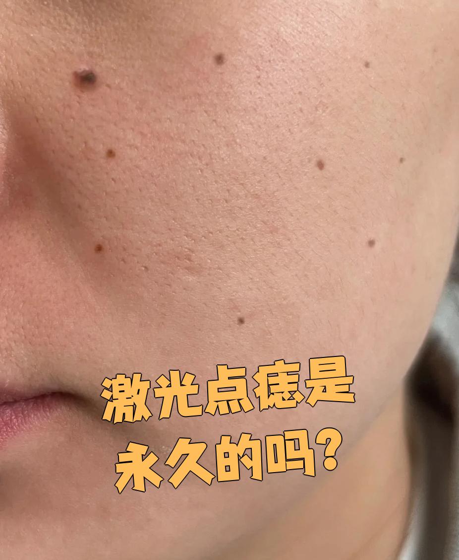 激光点痣的效果通常是永久性的,复发的可能性比较小
