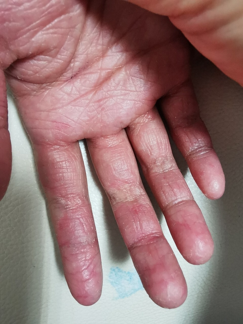 孩子的手周期性的脱皮严重怎么办 孩子十岁,从三岁开始,手部季节性的