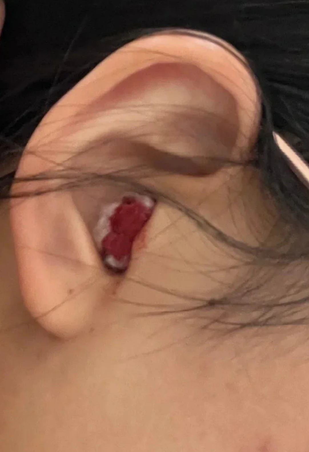 耳朵里有血块最常见的原因是外耳道损伤,鼓膜穿孔或慢性中耳炎