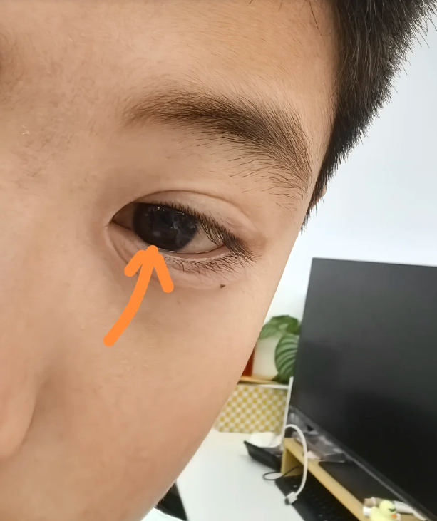 角膜云翳的治疗方法主要包括局部治疗,支持治疗和手术治疗三种