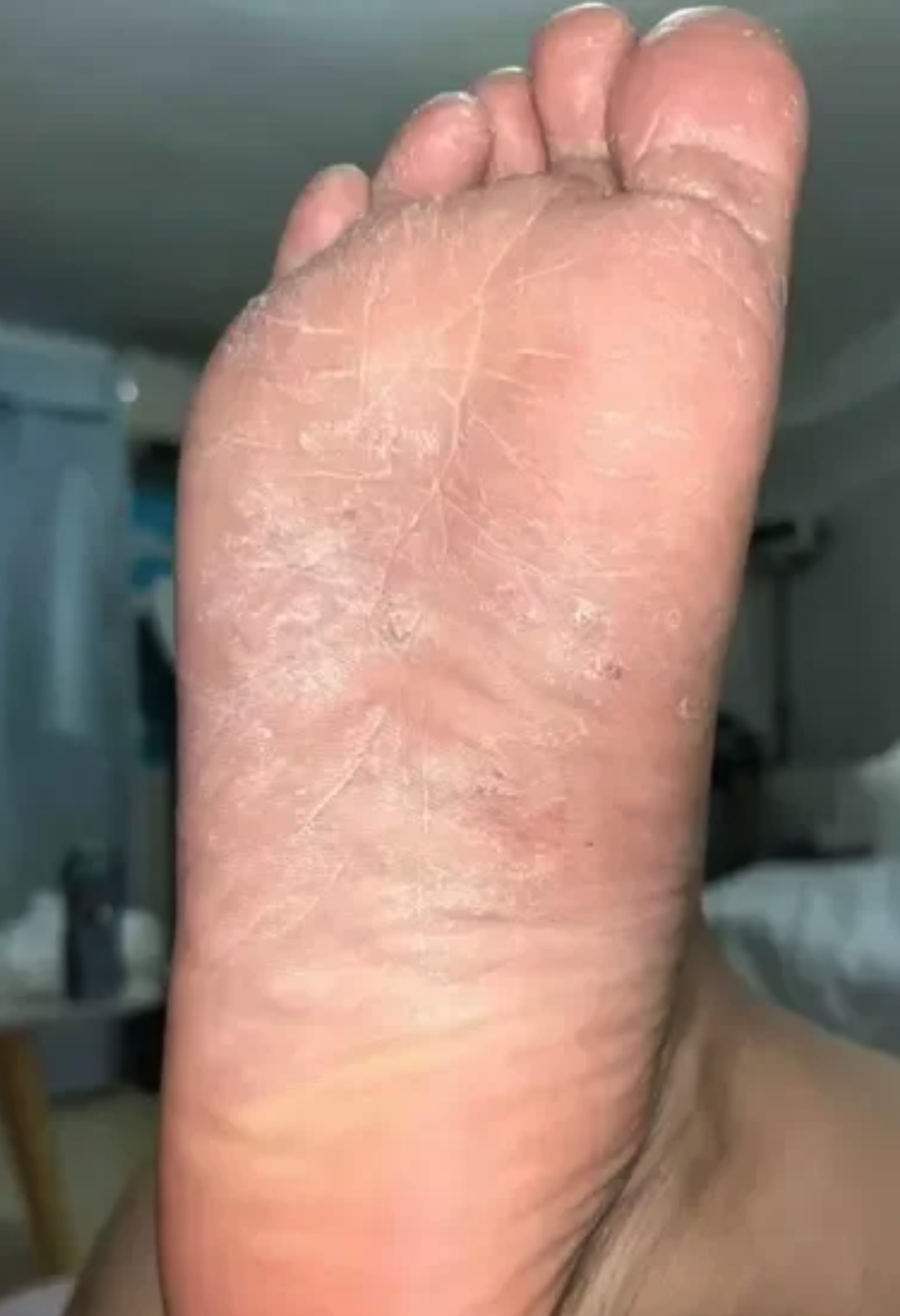 常见原因包括出汗多和足癣,多汗症等疾病