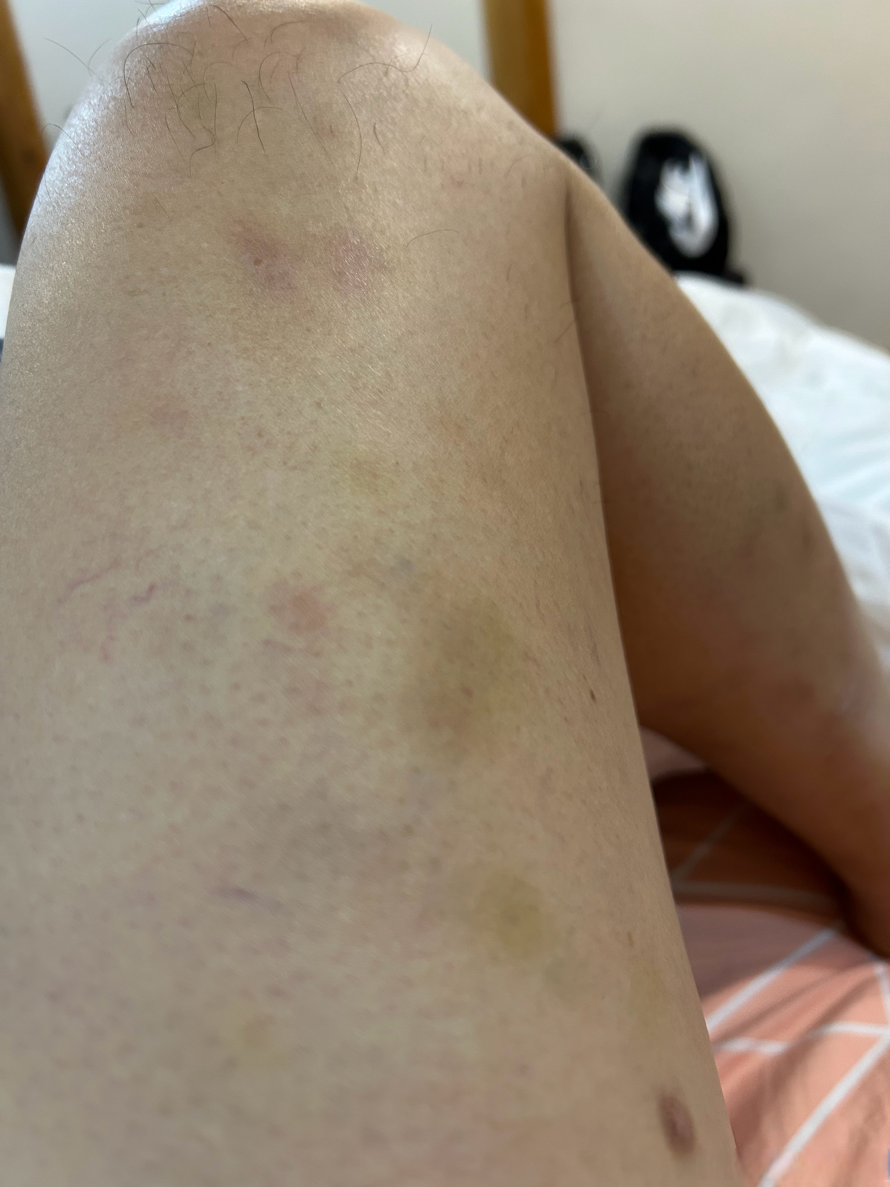 右腿大腿,外侧有按压紫色的痕迹