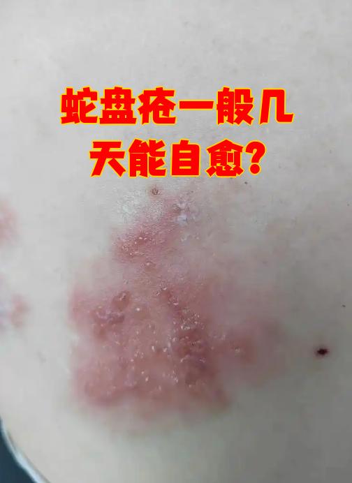 蛇盘疮通常需要2