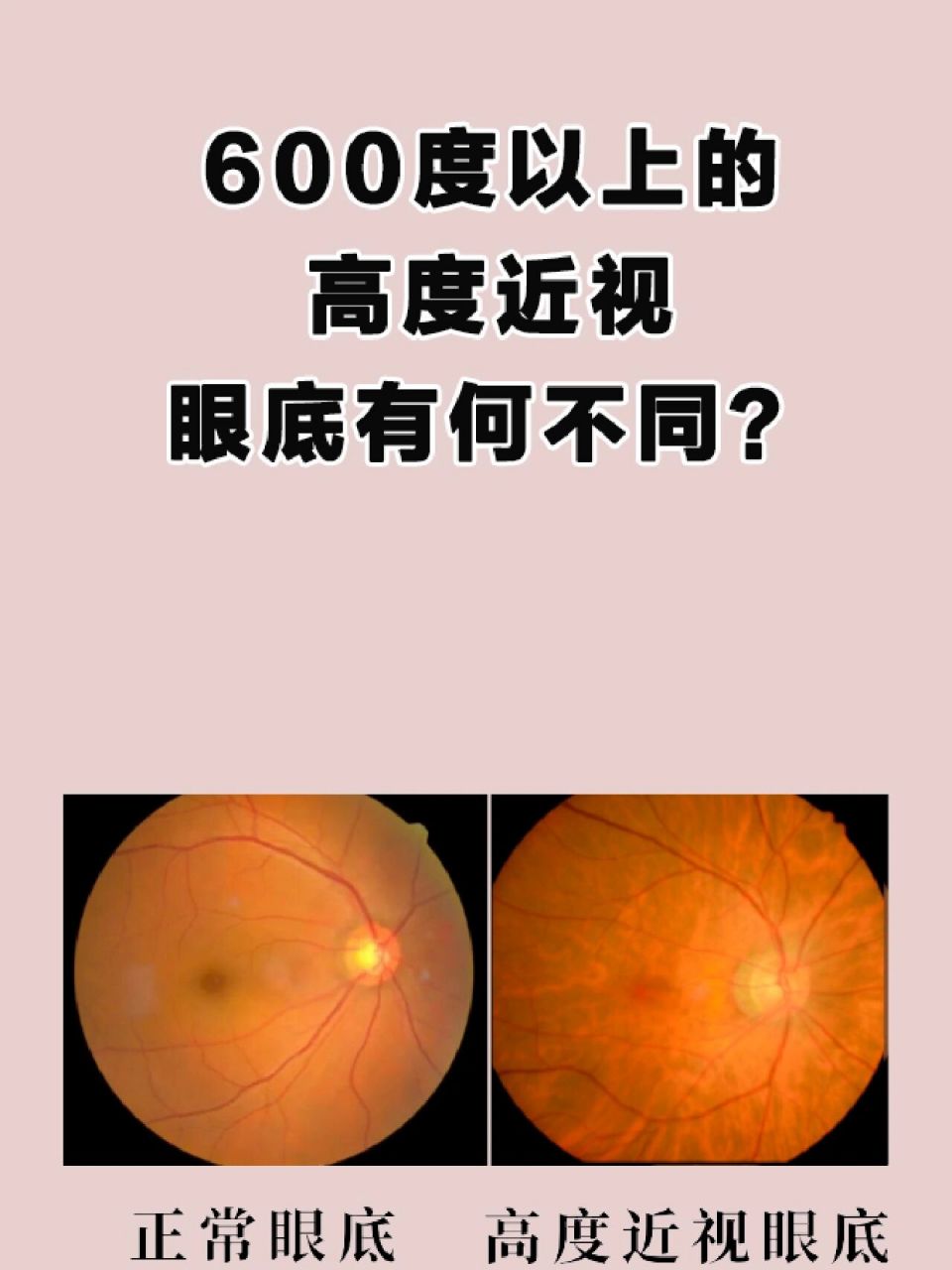 600以上的高度近视,眼底会裂开吗? 说起高度近视,大部分人的印象无非