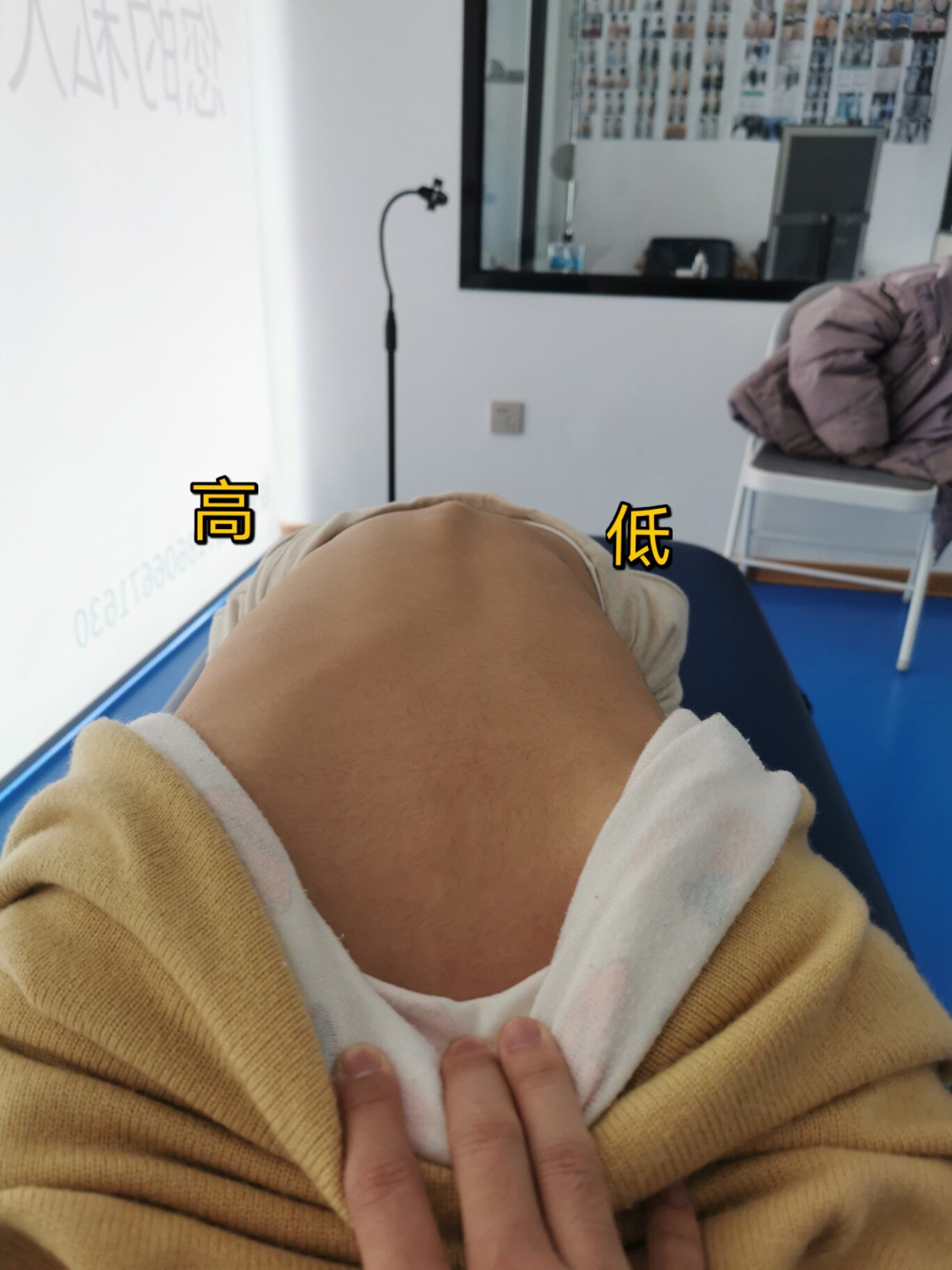 脊柱侧弯的前期症状