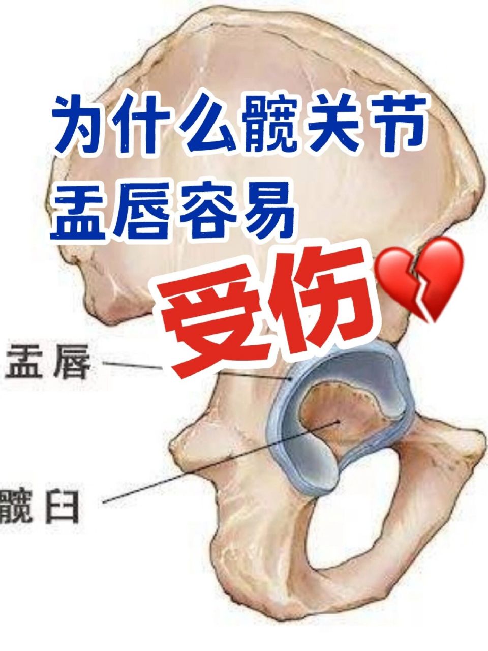 为什么髋关节盂唇容易受伤 盂唇损伤是造成腹股沟疼痛的原因之一,除了