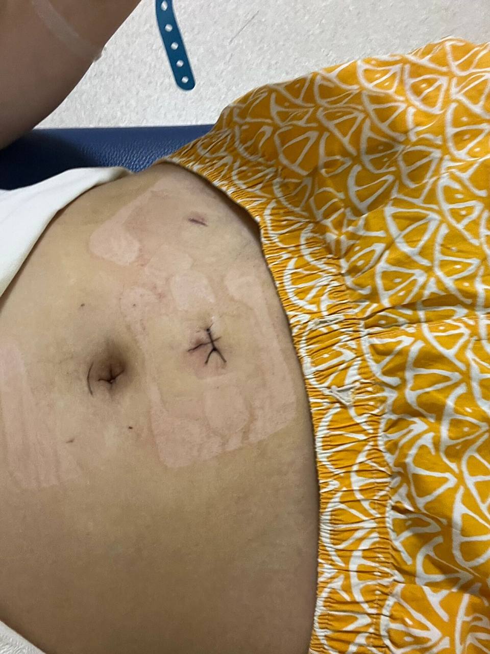 住院日记‖阑尾炎微创手术的小细节!