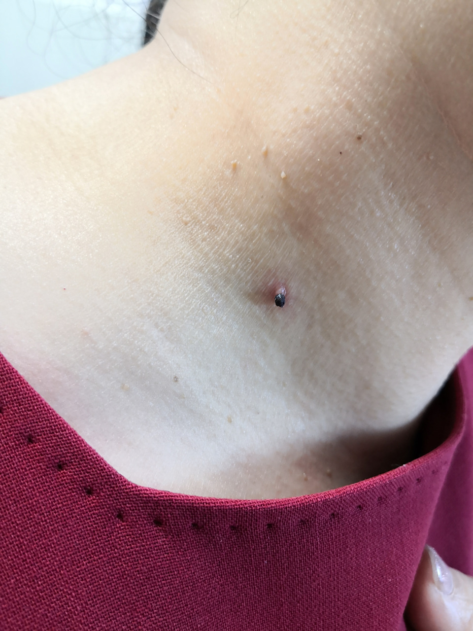 颈周皮赘色素痣#色素痣##激光美容# 可以手术切除或者激光治疗去除