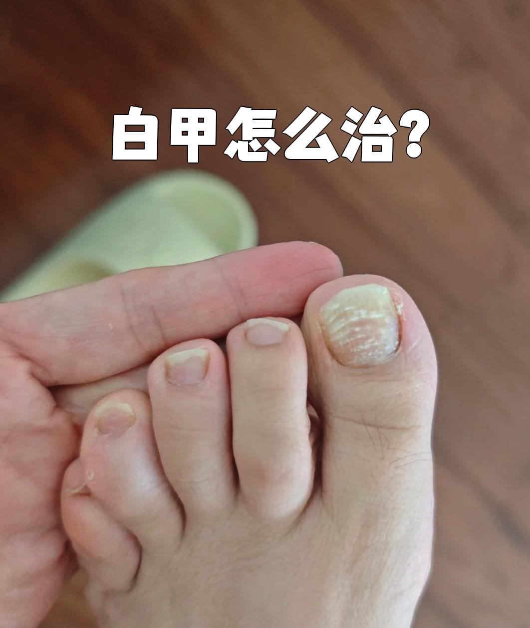 如果是生活习惯引起的,比如经常咬指甲,剪得太短,长期美甲或指甲受