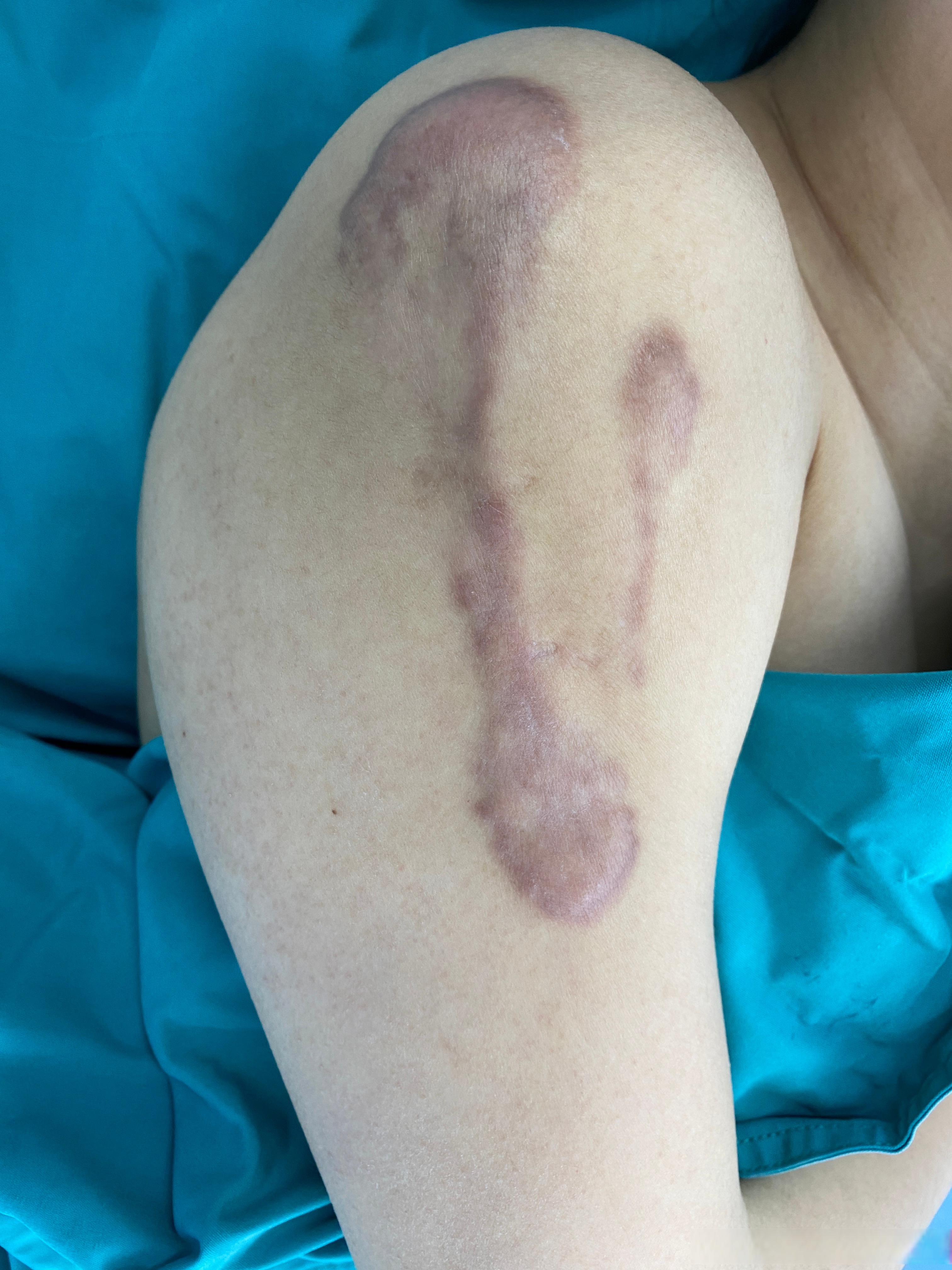 因为小时候打疫苗导致右上臂处疤痕,当时给她做了手